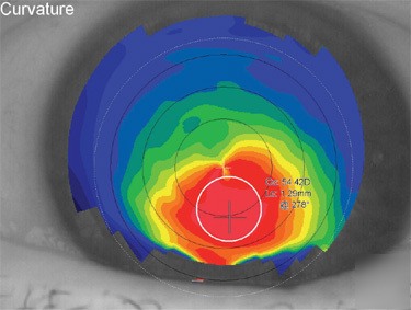 Keratron picolo corneal topographer
