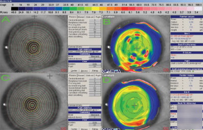 Keratron picolo corneal topographer